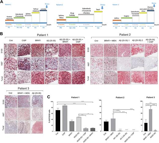 Figure 3. Aβ(25–35) reduces viability and induces cell death in ex vivo patient cultures. A, Patient's treatment history. B, Tumor slices were cultured in the presence of different treatments for 5 days and stained with IHC. PD, progressive disease; PR, partial response; SD, stable disease. Scale bar, 100 μm. C, QuPath was used to quantify the number of Ki67 positive cells. The average of 10 different areas was normalized to S100. One-way ANOVA was used for statistical analysis. **P, < 0.01; ***, P < 0.001; ****, P < 0.00001.