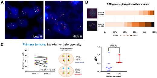 Figure 2. Increased heterogeneity is associated with metastasis. A, Heterogeneity in primary breast tumors. Tumors with low H have the same regions gained in most tumor cells as shown by homogeneity of FISH signals observed in individual tumor cells; tumors with high H have high heterogeneity of the combinations of regions gained for each tumor cell; some tumor cells show single/few FISH signals while other show multiple FISH signals. B and C, Intratumor or spatial heterogeneity in primary breast tumors. Two spatially separate areas of a tumor were assessed for H in 9 patients. Overall, the correlation coefficient for spatial heterogeneity was found to be moderate (r = 0.57, P = 0.048); however, it was quite striking in some patients. As an example, Patient 8 exhibits high intratumor or spatial heterogeneity between the two geographically separated tumor blocks, Block 1, H1 = 1.52 and Block 2, H2 = 2.53 (ΔH = 1.01). C, Association of ΔH and metastasis of primary breast tumors. Higher intratumor or spatial heterogeneity is associated with distant metastasis regardless of high average H (Havg) of the tumor.
