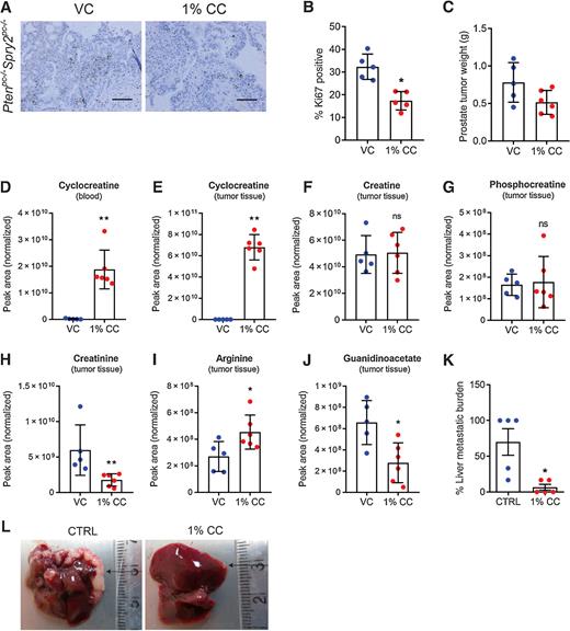 Figure 5. Cyclocreatine treatment affects prostate cancer progression in vivo. A, Representative Ki67 images of prostate tumor sections from Ptenpc-/- Spry2pc-/- mice treated for 1 month with vehicle (VC) or 1% cyclocreatine (n = 5 mice for each group; scale bar = 100 μm). B, IHC quantification of Ki67 in prostate tumors from Ptenpc-/- Spry2pc-/- mice treated for 2 months with vehicle (VC) or 1% cyclocreatine (CC; n = 5 mice for each group mean values ± SD are shown; *, P < 0.05; Mann–Whitney test). C, Non-cystic prostate tumor weights from Ptenpc-/- Spry2pc-/- mice treated for 1 month with vehicle (VC; n = 5) or 1% cyclocreatine (CC; n = 6); mean values ± SD are shown). D, Cyclocreatine abundance detected in whole blood of Ptenpc-/- Spry2pc-/- mice treated with 1% cyclocreatine (n = 6) or vehicle (n = 5). (Data show mean ± SD; **, P < 0.01; Mann–Whitney test). (E–J) Abundance of (E) cyclocreatine, (F) creatine, (G) phosphocreatine, (H) creatinine, (I) arginine and (J) guanidinoacetate detected in tumor tissues of Ptenpc-/- Spry2pc-/- mice treated with 1% cyclocreatine (n = 6) or vehicle (n = 5). (Data show mean ± SD; **, P < 0.01; Mann–Whitney test). K, Percentage PC3M liver metastases burden in CD-1 nude mice treated with control or 1% cyclocreatine (CC) water (ad libitum) for 1 month (n = 5 mice for each group; mean values ± SEM are shown; *, P < 0.05; Mann–Whitney test). L, Representative images of PC3M liver metastases in CD-1 nude mice treated with control or 1% cyclocreatine (CC) water (ad libitum) for 1 month (n = 5 mice for each group; arrows indicate liver metastases).