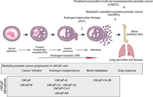 Figure 1. Schematic of prostate cancer progression showing the disease stages and the contribution of LNCaP cells and its derivatives to studying the disease stages.