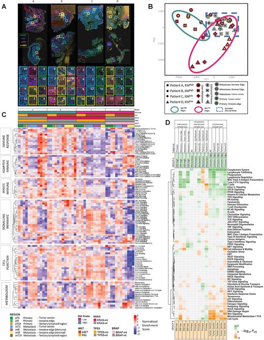 Figure 4. Spatially resolved transcriptomic analysis using Nanostring Cancer Transcriptome Atlas gene sets. A, Representative images of multiplex immunofluorescence (mIF) staining of 4 matched primary colorectal cancer and CRLM. DAPI (blue), Pancytokeratin (green), CD45 (pink), and a-SMA (yellow). Topographic regions are annotated, each box represents hand-selected area of tumor. 8 regions were taken from CRLM and 4 from primary colorectal cancer per patient. Patient A: KMhigh KRAS-wt, good prognosis. Patient B: KMhigh, KRAS-mt, good prognosis. Patient C: KMlow, KRAS/TP53 co-mutation, poor prognosis. Patient D: KM-low, KRAS-wt, BRAF-mt high-mutational burden lesion. B, Principal Component Analysis plot of all regions of interest (ROI) selected. The patient from whom the lesion originated is represented by shape. A red border indicates region arises from CRLM and white border represents primary colorectal cancer. The topographical region within the lesion is illustrated by the innermost color of the shape. KM high metastatic edges are represented by a green circle, KMlow metastatic edges are represented by a red circle and a dashed blue line represents epithelial regions of primary colorectal cancer and CRLM. C, Heatmap demonstrating single sample GSEA for every ROI, ordered on the x-axis by Patient and ROI. Key presented to aid patient identification. The y-axis represents annotated gene sets from Cancer Transcriptome Atlas ordered by and clustered within modules of Immune Response, Adaptive Immune, Innate Immune, Signaling Pathways. Cell Function, Metabolism. Each cell represents the Normalized Enrichment Score scaled by pathway. D, Heatmap demonstrating GSEA providing inter-patient comparison of selected areas between KMhigh and KMlow patients and intra-patient comparison between primary and metastatic sites and intralesional comparison between tumor center and immune edge. Subset of regions filtered before GSEA is demonstrated in Subgroup. Subsequent groups compared in GSEA identified as Groups A and B. Group A annotated at top of diagram and represented by green. Group B annotated at bottom of diagram and represented by orange. Cells of heatmap represent −log10(Padj) for comparison, cell is tinted green if pathway is upregulated in group A and orange if upregulated in group B.