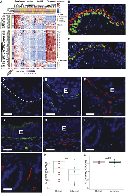 BM expression in DCIS. A, Relative expression of BM genes across the three major cell states and fibroblasts within each pseudobulk samples from scRNA-seq data (sample set 1). Displayed genes were most significantly upregulated (adj. P < 0.01) in each specific cell type compared with all other cell types. B, Detection of COL4A1 RNA (green) in DCIS epithelium (E) and adjacent stroma (S), with ACTA2 protein (red) expression demarcating the basal zone of the DCIS sample. C, Detection of LAMC2 RNA (green) in DCIS epithelium (E) and adjacent stroma (S), with ACTA2 protein (red) expression demarcating the basal zone of the DCIS sample. D, IF of LAMC2 in DCIS. The white dashed line indicates the edge of the DCIS. E, located adjacent to invasion (sample set 4). E, IF of ACTC2 in DCIS (E) located adjacent to microinvasion. F, IF of COL4A1 in DCIS (E) located adjacent to invasion. G, IF of LAMC2 in DCIS (E) located distant to invasion. H, IF of COL4A1 in DCIS (E) located distant to invasion. I, IF of LAMC2 in IBC. J, IF of COL4A1 in IBC. K, Comparison of percentage of continuity for LAMC2 in DCIS ducts between DCIS adjacent to invasion or distant to invasion. L, Comparison of percentage of continuity for COL4A1 in DCIS ducts between DCIS adjacent to invasion or distant to invasion. Scale bar, 20 μm.