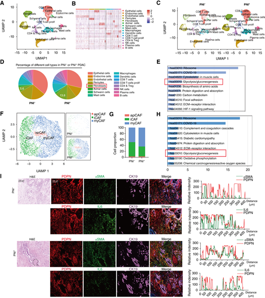 Metabolic reprogramming in pCAFs. A, Uniform Manifold Approximation and Projection (UMAP) plots of single cells identified by scRNA-seq, colored by major cell types. B, Heatmap displaying the most differentially expressed genes across each major cell type. C and D, UMAP plots and pie charts showing the distribution of different cell types in PDAC tissues with or without PNI. E, KEGG functional enrichment analysis of signaling pathway in CAFs from PDAC tissues with or without PNI. F and G, UMAP plots and bar plots displaying the reclustering of fibroblasts in scRNA-seq data from PDAC tissues with and without PNI. H, Gene set enrichment analysis of the glycolysis pathway comparing myCAFs with other CAF subtypes. I, Left, representative images of mIF staining for PDPN, αSMA, and CK19 in PDAC tissues with (PNI+) and without neural invasion (PNI−). PDPN was used as a pan-CAF marker, αSMA was used as a myCAF marker, IL6 was used as an iCAF marker, and CK19 was used as a tumor marker. The corresponding intensity plots of regions of interest (straight yellow lines) in the mIF image are displayed on the right, respectively. Red curves, PDPN relative fluorescence intensity; green curves, αSMA or IL6 relative fluorescence intensity. The red-green overlap represents the colocalization of PDPN with αSMA or IL6. Higher peak intensity indicates stronger fluorescence expression. The dotted line represents the boundary of the tumor. ImageJ was used to quantify fluorescence intensity in these areas. Scale bars, 200 μm.