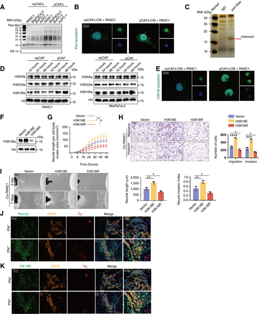pCAF-derived lactate regulates PNI through H3K18la. A–E, Tumor cells were treated with CM isolated from npCAFs or pCAFs and were used for subsequent experiments. A, Western blot of pan-lysine lactylation (Pan-Kla) levels in tumor cells treated as indicated. B, Immunofluorescence staining for Pan-Kla in PANC1 cells under the indicated treatments. Scale bar, 20 μm. C, Representative silver staining image of lactylation-associated proteins in PANC1 cells treated with pCAFs-CM. The red line highlights the protein bands enriched by the anti-lactylation antibody, which were subsequently analyzed by LC-MS. D, Western blot of H3K9la, H3K56la, and H3K18la in tumor cells treated as indicated. E, Immunofluorescence staining for H3K18la in tumor cells under the indicated treatments. Scale bar, 20 μm. F–I, PANC1 cells transfected with vector, plasmid with H3K18E (lysine to glutamate mutant), or plasmid with H3K18R (lysine to arginine mutant) were used for subsequent experiments. F, Western blot of H3K18la in PANC1 cells under the indicated treatments. G, Quantitative analysis of neurite length in the Transwell system under the indicated treatments. Phase contrast images of neuronal cells were acquired every 4 hours (n = 5 independent experiments; one-way ANOVA test; data are shown as the means ± SD). H, Representative image (left) and quantitative analysis (right) of PANC1 cell migration and invasion in the Transwell system under the indicated treatments. Scale bars, 200 μm. n = 3 independent experiments; one-way ANOVA test; data are shown as the means ± SD. I, Neuroinvasive capacity of PANC1 cells following the specified treatment. Scale bars, 500 μm. n = 3 independent experiments; one-way ANOVA test; data are shown as the means ± SD. J, mIF staining analysis of pan-lysine lactylation in PNI+ and PNI− PDAC tissues. Tuj1 was used as a neuron marker. CK19 was used as a tumor marker. Scale bars, 200 μm. K, mIF staining analysis of H3K18la in PNI+ and PNI− PDAC tissues. Tuj1 was used as a neuron marker, and CK19 was used as a tumor marker. Scale bars, 200 μm. *, P < 0.05; **, P < 0.01; ***, P < 0.001; ****, P < 0.0001.