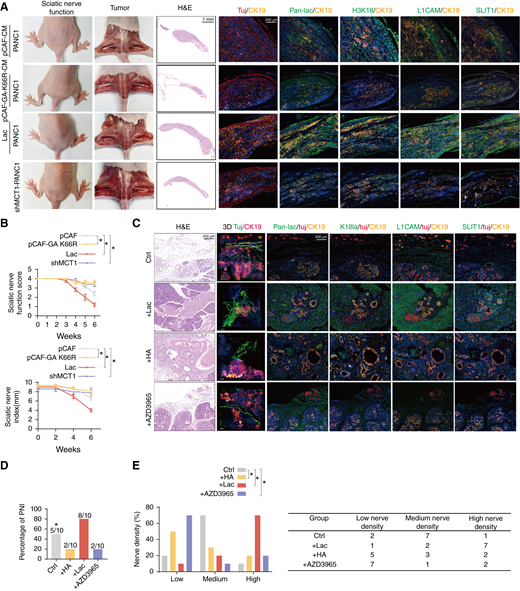 pCAFs enhance PNI of pancreatic cancer via lactate-mediated H3K18la in vivo. A, Gross and surgical images, hematoxylin and eosin (H&E) staining, and mIF images. mIF showed pan-lac, H3K18, L1CAM, and SLIT1 expression in the sciatic nerve invasion model. The dotted line indicates the tumor boundary. Tuj1 served as a neuronal marker, and CK19 was used as a tumor marker. H&E, scale bars, 1,000 μm. mIF, scale bars, 200 μm. B, Sciatic nerve function scores and sciatic nerve indexes of mice treated as indicated (n = 5 mice per group). Kruskal–Wallis test with Dunn multiple comparisons test; data are shown as the means ± SD. C–E, KPC mice (LSL-KRASG12D/+; LSL-TRP53R172H/+; PDX-1-CRE+/+) were divided into four groups, with three groups respectively receiving i.p. injections of sodium lactate (1 g/kg), oral administration of the MCT1 inhibitor AZD3965 (100 mg/kg), and i.p. injections of heptenoic acid (1 mg/kg). n = 10 mice per group. C, Representative hematoxylin and eosin staining. mIF and 3D reconstruction images showing PNI status and pan-lac, H3K18, L1CAM, and SLIT1 expression in KPC mice treated as indicated. Tuj1 served as a neuron marker. CK19 was used as a tumor marker. Hematoxylin and eosin and mIF, scale bars, 200 μm. 3D scale bars, 500 μm. D, Proportion of PNI in KPC mice under the specified treatments (n = 10 mice per group). Fisher exact test. E, Nerve density percentage (left) and number (right) in KPC mice following the indicated treatments (n = 10 mice per group; χ2 test). *, P < 0.05. HA, heptenoic acid.