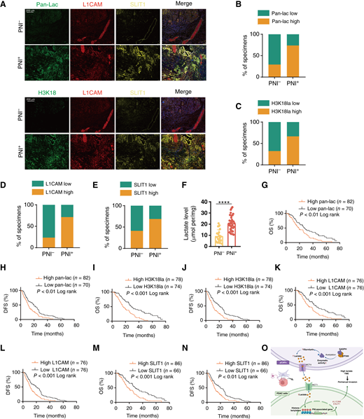 Pan-lac/H3K18la is associated with PNI and poor prognosis in patients with PDAC. A, mIF results for pan-lac, H3K18, L1CAM, and SLIT1 expression in patients with PDAC (n = 152). Scale bars, 200 μm. B–E, Quantitative breakdown of the specimen percentages featuring low or high expression of pan-lac (B), H3K18 (C), L1CAM (D), and SLIT1 (E) across PNI− and PNI+ groups. F, Lactate levels of PNI− and PNI+ tissues. G–N, Kaplan–Meier analysis of overall survival (OS) and DFS of patients with PDAC categorized by high or low pan-lac expression (G and H), high or low H3K18 expression (I and J), high or low L1CAM expression (K and L), and high or low SLIT1 expression (M and N). O, Schematic illustration delineating the mechanism by which pCAFs promote pancreatic cancer PNI by shaping a high-lactate TME, upregulating tumor cell histone H3K18la and transcriptionally activating the expression of genes associated with neural infiltration. Data are presented as mean ± SD. ****, P < 0.0001. O, Created with BioRender.com. Hu, C. (2025) https://BioRender.com/h04t962.