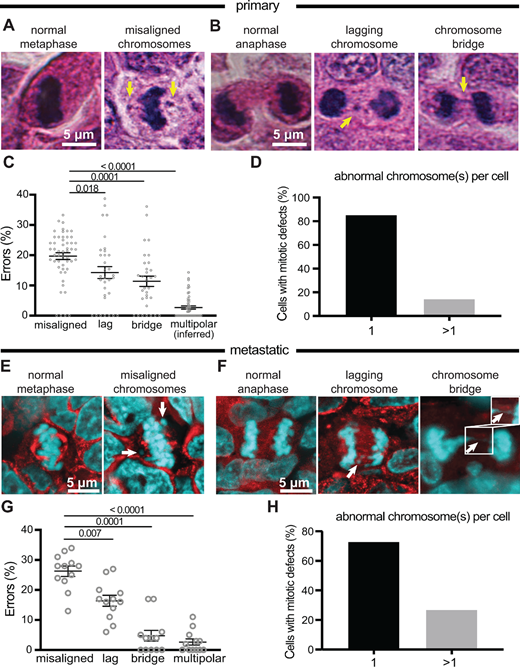 Misaligned chromosomes are the predominant mitotic error in primary and metastatic breast tumors. A and B, H&E images of normal and abnormal mitotic cells in primary breast cancer. Arrows indicate respective defects. C, Distribution of mitotic defects in primary breast tumors showing that misaligned chromosomes occur most frequently. n = 1,742 metaphase cells observed in 52 patients. n = 569 anaphase and telophase cells observed in 32 patients. D, Number of abnormal chromosomes in primary tumor cells with mitotic defects showing that, typically, only a single chromosome is affected. E and F, Immunofluorescence images of normal and abnormal mitotic cells in metastatic breast cancer. Arrows denote indicated defects. Inset in F shows that the DNA bridge is continuous. G, Distribution of mitotic defects found in 12 metastatic breast tumors showing that misaligned chromosomes are the most common defect. n = 52 metaphase and 20 anaphase and telophase cells on average per case. H, Number of abnormal chromosomes in metastatic cancer cells with mitotic defects showing that in the majority of divisions, only a single chromosome is affected. P values derived from unpaired t tests.