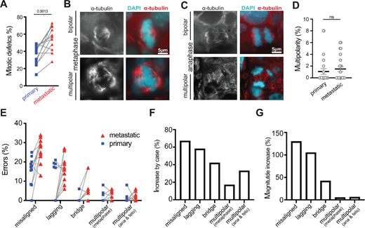 CIN increases as tumors progress, predominantly due to an increase in misaligned chromosomes. A, Comparison of total mitotic defects in paired primary and metastatic breast cancer patient samples. Lines connect paired primary and metastatic tumor samples. B, Bipolar (top) and multipolar (bottom) metaphase spindles. C, Bipolar (top) and multipolar (bottom) anaphase spindles. D, Quantification of spindle multipolarity in 12 primary and 12 metastatic breast cancer samples showing a range of low levels of multipolarity in both. P = 0.0527 derived from unpaired t test. E–G, Quantification of mitotic defects in matched primary and metastatic breast tumors. n = 364 and 628 metaphase cells observed in 12 primary and metastatic patient samples, respectively. n = 178 and 239 anaphase and telophase cells observed in 12 primary and metastatic patient samples, respectively. E, Incidence of multipolar spindles and misaligned, lagging, and bridge chromosomes in matched primary and metastatic breast cancers. Matched cases are connected by gray lines. F, The percentage of cases in which the indicated defect increased by ≥1 SD in the metastatic as compared with the primary site. G, The magnitude of the observed change in each defect summed across all cases. ns = not significant.