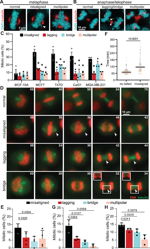 Misaligned chromosomes that persist until anaphase onset are a major cause of CIN in breast cancer. A and B, Immunofluorescence images of T47D cells. Arrowheads denote indicated defects. C, Frequencies of mitotic defects (mean ± SD) in nontransformed (MCF10A) and breast cancer cell lines showing that metaphase cells with a well-defined metaphase plate and one or more misaligned chromosomes that are clearly separated from the plate predominate. n > 150 metaphase cells and 150 anaphase+telophase cells in three biological replicates. *, P < 0.05, unpaired t test. D, Still images from timelapse analysis of mitotic defects in T47D cells with endogenously labeled histone H2B and α-tubulin, to label DNA and microtubules, respectively, showing normal division (top; Supplementary Movie S1), a misaligned chromosome that persists through anaphase onset (row 2; Supplementary Movie S2), a lagging chromosome (row 3; Supplementary Movie S3), and a chromosome bridge (bottom; Supplementary Movie S4). E, Quantification of mitotic defects in Cal51 cells with endogenously labeled histone H2B and α-tubulin imaged at 5-minute intervals. n = 40–73 mitotic cells in each of four biological replicates. F, Duration of mitosis (NEB to daughter cell flattening) in Cal51 cells with and without misaligned chromosomes in E, showing cells with misaligned chromosomes in metaphase exhibit a substantial mitotic delay. G and H, Quantification of mitotic defects observed using timelapse microscopy in endogenously tagged Cal51 (G) or T47D (H) cells with 2-minute acquisition intervals. n = 41–74 cells in each of three biological replicates. P values derived from unpaired t tests.
