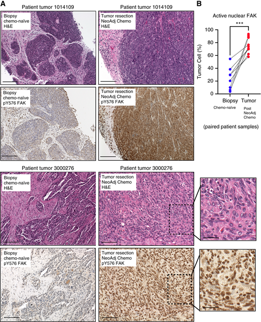 Active FAK staining increases in the nucleus of HGSOC patient tumors after neoadjuvant chemotherapy. A, IHC staining of paraffin-embedded serial initial tumor biopsy sections (patient 1014109 and patient 3000276) and corresponding tumor resection after neoadjuvant chemotherapy treatment. Samples were stained with H&E and phosphospecific antibodies to the FAK activation loop Y576 (pY576) within the kinase domain. Scale is 100 μm (inset scale is 25 μm). B, Image quantification of percent of tumor cell area exhibiting FAK pY576 staining. Paired tumor samples (n = 8) from initial biopsy (blue circles) and from surgical tumor debulking after neoadjuvant chemotherapy (red circles). Dotted lines connect paired patient tumor samples collected prior to and after neoadjuvant chemotherapy (***, P < 0.001). Chemo, chemotherapy; H&E, hematoxylin and eosin; NeoAdj, neoadjuvant.
