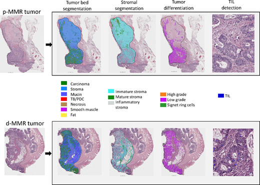 QuantCRC detects tumor morphologic features in four layers. TB/PDC, tumor budding/poorly differentiated cluster; TIL, tumor-infiltrating lymphocytes. https://cloud.aiforia.com/Public/MayoUpmcAiforia_Pai/0z9TK9WQComQSW5MOEo_1KieA8U9KX9oCFbc2SQ-ioM0. To see the QuantCRC analysis click on the image, then click on “analyze,” and then click on the thumbnail of the image.
