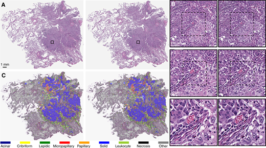 A, Example of real (left) and virtual (right) stains for a H&E WSI. B, Magnification series of real (left) and virtual (right) stains for concentric regions from the WSI at 10× (top), 20× (middle), and 40× (bottom) magnifications. C, Example of the segmentations on real (left) and virtual (right) stains obtained from automatic histologic subtyping.