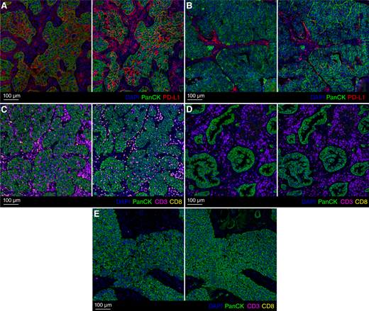 Examples of real (left) and virtual (right) stains showing key immune phenotypes. A, PD-L1–positive tumor. B, PD-L1–negative tumor. C, Immune-inflamed tumor with T-cell infiltration. D, Immune-excluded tumor with T-cell accumulation in surrounding stroma. E, Immune-desert tumor with no T cells.