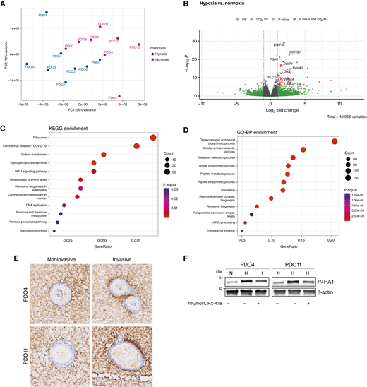 Comparison of transcriptomes and molecular pathways of invasive normoxic and hypoxic organoids. A, Principal component analysis plot of gene expression in hypoxic invasive organoid samples (n = 8). PC, principal component. B, Volcano plot of differentially expressed genes between normoxic and hypoxic invasive organoids. FC, fold change. C, Pathway analysis of normoxic and hypoxic invasive organoids using KEGG processes. D, Pathway analysis of normoxic and hypoxic invasive organoids using GO Biological Processes (GO-BP). E, IHC for hydroxyproline surrounding invasive and noninvasive organoids in PDO4 and PDO11. F, Western blot analysis assessing P4HA1 levels in 2D cultures prepared from PDO4 and PDO11 organoids 24 hours after treatment with a HIF1a inhibitor (10 μmol/L PX-478). H, hypoxia; N, normoxia.