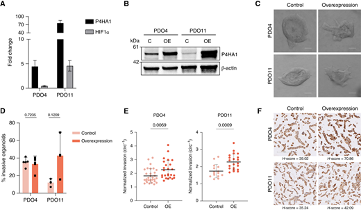 Overexpression of P4HA1 increases invasiveness in PDAC PDOs in normoxia. A, Expression level of P4HA1 measured by qRT-PCR. Fold changes, expressed relative to the modified control samples, represent a mean of three technical replicates with SDs. B, Western blot analysis to confirm the effectiveness of P4HA1 overexpression in PDO4 and PDO11 compared with the empty vector. C, Representative images of invasive empty vector–modified and overexpressed P4HA1–modified organoids in normoxia. Scale bars, 100 μm. D, Effect of P4HA1 overexpression on invasion in modified PDO4 and PDO11 organoids. Percent invasion represents a mean of three biological replicates with SDs. Each biological replicate n > 30 organoids (P = 0.7235 and P = 0.1209, t test). E, Inverse circularity scores of empty vector–modified and P4HA1 overexpression–modified PDO4 (n = 31 and n = 25, respectively; P = 0.0069, t test) and PDO11 (n = 15 and n = 21, respectively; P = 0.0009, t test) organoids in normoxia. F, IHC for hydroxyproline in HistoGel-embedded cell pellets prepared from 2D cultures of PDO4 and PDO11 P4HA1 overexpression and control lines. C, control; OE, overexpression.