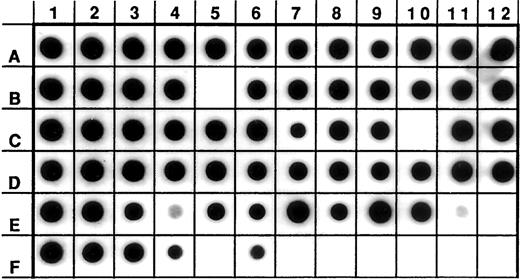 Fig. 1. Detection of human β-globin DNA amplification in test specimens. An aliquot from each of 56 specimens (DNA from 25 mesotheliomas, 25 normal lung tissues, and the negative and five positive SV40 controls) was tested by PCR amplification using primers GH20/PC04 and dot blot hybridization with probe PC03. The blank positions were all laboratory controls, as were positive positions E3 and E11. F1–F4 were replicates of a single test specimen, and F6 was a replicate of the test specimen in A1. The remaining test specimens were assayed once each. All test specimens were β-globin positive.