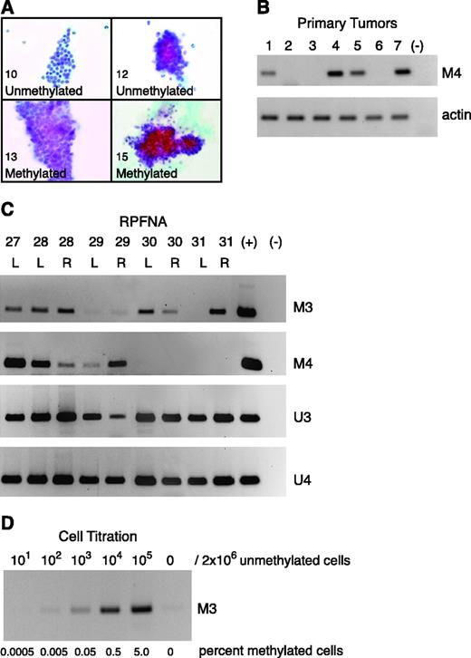Figure 2. RPFNA cytology and methylation of RARβ2 P2 promoter. A. Representative RPFNA specimens in high-risk women. Numeric value, Masood cytology index score for this specimen. Presence of RARβ2 P2 promoter methylation at either the M3 or M4 region (Methylated). If neither region is methylated, the specimen is labeled Unmethylated. B. Hypermethylation of RARβ2 P2 promoter M4 region in early-stage breast cancer specimens. To confirm the integrity of the extracted genomic DNA, PCR analysis was used to detect β-actin (actin). C. Hypermethylation of RARβ2 P2 promoter M3 and M4 regions in RPFNA obtained from five representative high-risk women. D. Hypermethylation of RARβ2 P2 promoter M3 region in cellular sensitivity experiment to measure lowest threshold of methylation detection in a sea of unmethylated DNA, as explained in Materials and Methods. M3 and M4, use of primers to identify methylated RARβ2 P2 regions 3 and 4, respectively. U3 and U4, use of primers to identify unmethylated RARβ2 P2 regions 3 and 4, respectively. Methylated positive control in the M3 and M4 gels, HMEC-SR in the U3 gel, and HS578T in the U4 gel (+). Negative control (−).