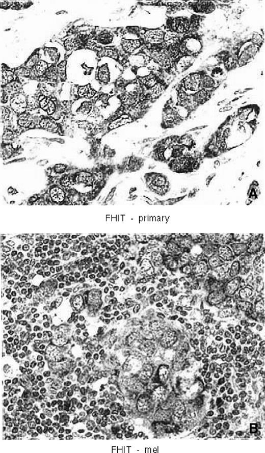Figure 1. A. Immunohistochemical staining of FHIT in primary breast tumor. B. Immunohistochemical staining of FHIT in metastatic lymph node.