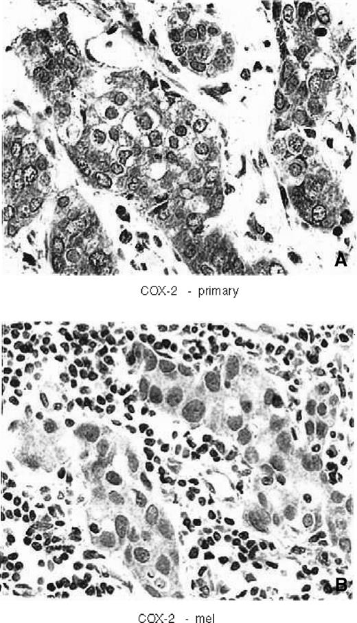 Figure 2. A. Immunohistochemical staining of COX-2 in primary breast tumor. B. Immunohistochemical staining of COX-2 in metastatic lymph node.