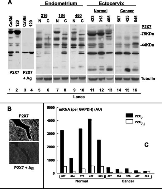 Figure 1. A. Western blots using the anti-P2X7 antibody in the absence (lanes 1, 2, and 5-16) or presence (lanes 3 and 4) of the P2X7 antigen. Numbers at the top of the figures, patients' coded identifiers. Case 120 was normal endometrium. In cases 216, 164, and 460, endometrial normal (N) and cancer (C) tissues were obtained from the same woman. Where indicated, gels were reprobed with anti-tubulin antibody. Coincubation of the anti-P2X7 antibody with the P2X7 antigen blocked expression of the 65 to 85–kDa (P2X7) and the 42 to 45–kDa (P2X7-j) immunoreactivities. B. Immunostaining of normal endometrium with anti-P2X7 antibody in the presence or absence of the P2X7 antigen. The experiment was repeated thrice with similar trends. C. P2X7 (black columns) and P2X7-j (white columns) mRNA assayed by real-time reverse transcription-PCR using normal and cancer endometrial tissues obtained from women with the designated codes.