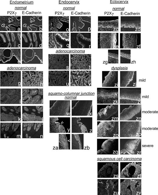 Figure 2. Immunostaining of endometrial (a-n), endocervical (o-z), and ectocervical (w-zv) normal (a-f, o-r, and w-zh), dysplasia (zi-zr), and cancer tissues [endometrial (g-n) and endocervical (s-v) adenocarcinomas and squamous cell carcinoma (zs-zv)] with the anti-P2X7 antibody (a, c, e, g, i, k, m, o, q, s, u, w, y, za, zc, ze, zg, zi, zk, zm, zo, zq, zs, and zu) or with the anti-E-cadherin antibody (to show the epithelial components of the tissues; b, d, f, h, j, l, n, p, r, t, v, x, z, zb, zd, zf, zh, zj, zl, zn, zp, zr, zt, and zv). zi to zl, mild cervical dysplasia; zm to zp, moderate cervical dysplasia; zq and zr, severe cervical dysplasia. a to d, o to r, and zi to zr, obtained from women ages 35 to 47; e, f, w to zb, zg, zh, and zs to zt, obtained from women ages 55 to 67. In sections containing normal endometrial glands plus endometrial cancer (k-n), the anti-P2X7 antibody stained the normal glands (k, four glands in the middle; m, two glands at the left bottom corner) but not the cancerous tissues. y, arrowhead, endocervical columnar (upward)–squamometaplastic (downward) junction. za, arrowhead, squamometaplastic (upward)–squamous (downward) junction. ze and zf, hyperkeratosis. The experiments were repeated two to four times with similar trends. Magnification, ×4 to ×20.