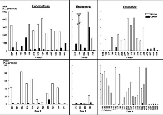 Figure 4. Case-based analysis of tissue expression of P2X7 mRNA (top) and P2X7 protein (bottom). Endometrial, endocervical, and ectocervical tissues were obtained from the women identified with the designated codes. In some cases, normal (white columns) and cancer (black columns) tissues were obtained from the same woman. P2X7 mRNA levels in each tissue were normalized to glyceraldehyde-3-phosphate dehydrogenase (GAPDH) mRNA (determined by real-time PCR), and P2X7 protein levels were normalized to tubulin protein levels (determined by densitometry of the 65-85–kDa complex of the Western blots). AU, arbitrary units.