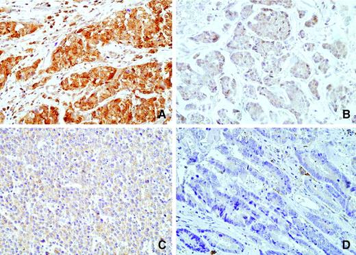 Figure 1. FHIT expression in various tumors (magnification, ×40). A, breast carcinoma with normal FHIT expression (score 9); B, breast carcinoma with reduced FHIT expression (score 3); C, liver carcinoma with reduced FHIT expression (score 3); D, colorectal adenocarcinoma with absent FHIT expression (score 0).