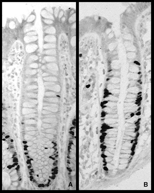 Figure 1. Colon crypt stained with Ki67 proliferation marker. A. Normal crypt. B. Crypt from normal mucosa of colon cancer patient. Note higher Ki67 staining at luminal edge (top) of crypt.