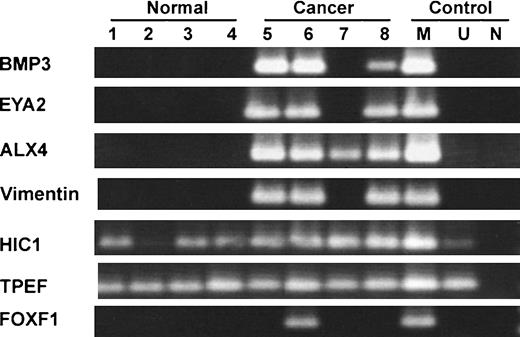 Figure 2. Tumor-specific methylated gene markers selected for study. Among 41 candidate genes, BMP3, EYA2, ALX4, and vimentin were methylated in at least three of four of the colorectal cancers, but in none of four normal colon tissues screened. HIC1, TPEF, and FOXF1 as representative of less specific or less sensitive markers for comparison. Universally methylated DNA and water were amplified as positive control and negative control, respectively.
