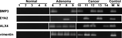 Figure 3. Neoplasm-specific methylation of BMP3, EYA2, ALX4, and vimentin genes. Methylation status was determined by conventional MSP using methylation-specific primers. Representative tissues from normal colon epithelia, adenomas, and cancers. Universally methylated DNA and water were amplified as positive and negative controls, respectively.
