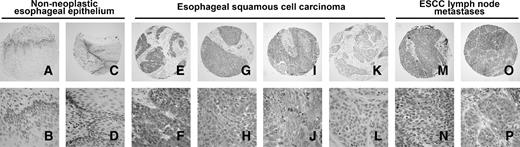 Figure 1. Representative results of immunohistochemical staining of DJ-1. Top, tissue cores at ×100 magnification; bottom, tissue cores at ×400 magnification. A and B. A nonneoplastic esophageal epithelium specimen shows negative staining of DJ-1 in both cytoplasmic and nuclear regions. C and D. A nonneoplastic esophageal epithelium specimen shows negative cytoplasmic and a high level of nuclear staining of DJ-1. E and F. An ESCC specimen shows high-level staining of DJ-1 in both cytoplasmic and nuclear regions. G and H. An ESCC specimen shows a moderate cytoplasmic and a strong nuclear staining of DJ-1. I and J. An ESCC specimen shows a high level of cytoplasmic and a low level of nuclear staining of DJ-1. K and L. An ESCC specimen shows a low level of DJ-1 staining in both cytoplasmic and nuclear regions. M and N. An ESCC lymph node metastasis specimen shows a high-level staining in both cytoplasmic and nuclear regions. O and P. An ESCC lymph node metastasis specimen shows a high level of cytoplasmic staining and a low level of nuclear staining of DJ-1.