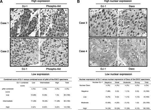 Figure 5. DJ-1 expression is positively correlated with pAkt and Daxx expression. A. Combined score of DJ-1 was positively correlated with combined score of pAkt (r = 0.301; P = 0.009). Two representative cases are presented with the uppercase showing high combined score of both DJ-1 and pAkt, whereas the lowercase showing low combined score of both DJ-1 and pAkt. A cross-tabulation of combined DJ-1 and pAkt score in our ESCC patient cohort is presented underneath the two representative cases. These results suggest that DJ-1 might promote ESCC progression through activation of PI3K pathway. B. Nuclear DJ-1 expression, but not cytoplasmic or combined score of DJ-1, was significantly correlated with nuclear Daxx expression (r = 0.296; P = 0.01). Two representative cases are presented with the uppercase showing high level of nuclear expression of DJ-1 and Daxx, whereas the lowercase showing low level of nuclear expression of DJ-1 and Daxx. A cross-tabulation of nuclear expression of DJ-1 and Daxx is presented underneath the two representative cases. These results suggest that DJ-1 might sequester Daxx in the nuclear region and inhibiting its function on apoptosis.