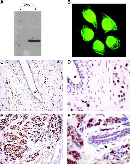 Figure 2. TWIST1 protein analysis. A. Western blot analysis for TWIST1 of MCF-7 cells either overexpressing TWIST1 or control. B. Immunofluorescence of endogenous TWIST1 in HeLa cells. Clear nuclear staining is observed together with some cytoskeletal staining. C to F. Immunohistochemistry of TWIST1 in breast carcinoma. Normal breast ducts (asterisk) show moderate TWIST1 expression in the nuclei and are surrounded by invasive cancer cells that are strongly positive for TWIST1. Magnification, ×10 (C and D) and ×63 (E and F).