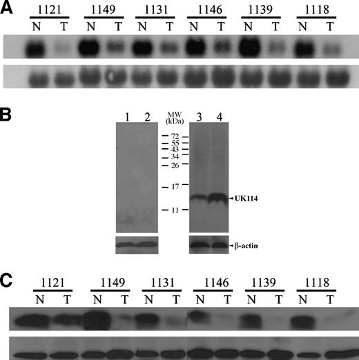 Figure 2. Expression of UK114 in human hepatocellular carcinoma tumor tissues versus its adjacent normal tissues. A. Expression of UK114 mRNA in six representative pairs of hepatocellular carcinoma tumor tissues (T) and their adjacent normal tissues (N) was detected by Northern blot analysis with a human UK114-specific cDNA probe (top). The level of 18S rRNA was used as an internal control for the adjustment of the RNA loading (bottom). B. Specificity of polyclonal antibody against UK114 was examined by Western blot analysis. The human hepatoma HuH7 cells were transfected with control vector (lanes 1 and 3) or UK114 expression vector (lanes 2 and 4). The cell lysates were prepared and detected by preimmune serum (lanes 1 and 2) or polyclonal antibody against UK114 (lanes 3 and 4). The level of β-actin was used as an internal control for the adjustment of protein loading. C. Expression of UK114 protein in the same batch of hepatocellular carcinoma specimens was detected by Western blot analysis using the anti-UK114 polyclonal antibody (top). The level of β-actin was used as an internal control for the adjustment of protein loading (bottom).