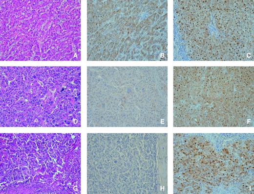 Figure 4. Representative immunohistochemistry of UK114 in human hepatocellular carcinoma tumor tissue and adjacent normal liver tissue (magnification, ×400). Expression level of UK114 was higher in the normal liver tissue compared with tumor tissue. Left, H&E staining of the sample (A, D, and G). Middle (B, E, and H) and right (C, F, and I), immunohistochemistry of UK114 in the adjacent normal liver tissue and tumor liver tissue, respectively. All of the tissue sections were graded according to Edmondson-Steiner classification. Representatives of grade 2 hepatocellular carcinoma (moderate differentiation; A-C). Representatives of grade 3 hepatocellular carcinoma (poor differentiation; D, E, and H). Representatives of grade 4 hepatocellular carcinoma (undifferentiation; G-I).