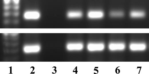Figure 2. PSMA mRNA by reverse transcription-PCR in human EAC. Lane 1, marker; lane 2, LNCaP cell line (considered as positive control); lane 3, negative control, lanes 4 to 8, example of human EAC.
