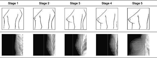 Figure 1. Breast pubertal stages according to Tanner with the corresponding DXA image. The total breast area is shown as the largest region of interest around the breast (blue).