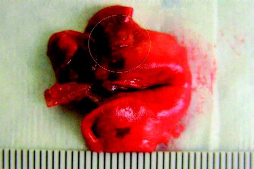 Figure 1. Gross tumor nodules (circled) in the lungs of the surviving tumor-bearing animal on day 48 after tumor cell implantation. Rats were anesthetized and received either intratracheal PBS or 1 × 107 H460 cells. Scale is millimeters.
