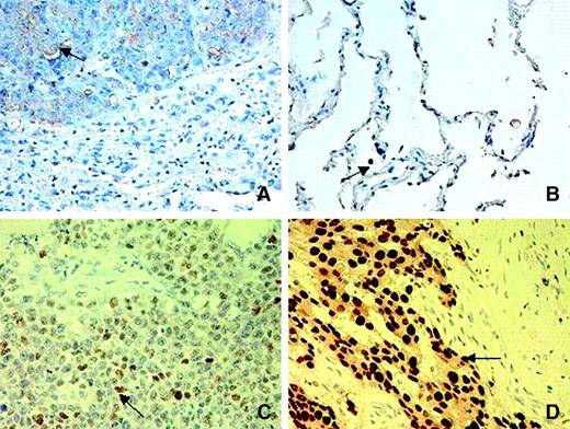 Figure 4. H460 tumor in immunocompromised rat lung. A. Positive membrane and cytoplasmic staining of human IL-8 can be seen in the tumor cells on the upper half of the photograph. B. Normal human lung positive control with positive cytoplasmic staining of human IL-8 in alveolar macrophages. Magnification, ×40. C. Positive nuclear staining of human p53 can be seen in the tumor cells. Magnification, ×40. Human breast adenocarcinoma was used as a positive control for p53. D. Human breast adenocarcinoma positive control with positive nuclear and cytoplasmic staining of human p53 in tumor cells. Magnification, ×40.