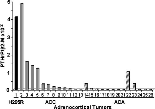 Figure 1. Adrenocortical tumors, H295R (lane 1); ACC (lanes 2-13); ACA (lanes 14-26). Quantitative PCR assays of PTHrP gene (exons 5/6, 93 bp amplicon) and β2-microglobulin gene activities (done in duplicate). Data were normalized using the ratio of the PTHrP cDNA concentration to that of β2-microglobulin (β2-M) mRNA to correct for differences in the quantities of RNA in samples. The PTHrP/β2-microglobulin ratio was higher (10-fold) in carcinoma samples than in adenoma samples (P < 0.006).