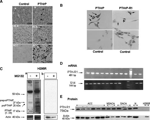Figure 2. PTHrP and PTH-R1 synthesis. A, right, immunohistochemical staining of ACT sections; positive cells (arrows): normal (N), adrenocortical adenoma (ACA), adrenocortical carcinoma (ACC). PTHrP immunohistochemistry of normal tissue showing its cytoplasmic/nuclear location in some endothelial cells and in vacuolated cells of the zona fasciculata. ACA sections with positively stained cells within the interstitial tissue delimiting the nodules. ACC sections contain extensive, dense, positively stained cells with foci in the vacuolated cells. Left, control sections incubated with rabbit anti-IgG showing no staining. B. Immunostaining of PTHrP and PTHrP receptors in the H295R cell line. The negative control was incubated with rabbit IgG for PTHrP and with mouse IgG for the PTHrP receptor (bottom). C. Western blot of PTHrP in H295R cells using monoclonal antibody to PTHrP(1-34). a. Left lane, the blot shows multiple peptide bands: 25 and 27 kDa for pre–pro-PTHrP, 35 and 50 kDa bands indicating products of proteolysis, and a faint 17 kDa PTHrP(1-34) band. Right lane, the immunoreactive bands were enhanced after treatment with the antiprotease MG132. Actin was used to assure equal loading. b. Western blot of the same samples incubated with anti-PTHrP antibody that had been incubated with its blocking antigen, showing the specificity of the multiple bands. D. Real-time PCR of the PTH/PTHrP receptor (PTH-R1) showing one 481-bp band in all the tumor samples. The ratio of PTH-R1 mRNA to S14 mRNA was not significantly different between tumors. E. Western blot of the PTH/PTHrP receptor showed one 75 kDa band. Nonsecreting adrenocortical adenoma (NSACA); secreting adrenocortical adenoma (SACA).