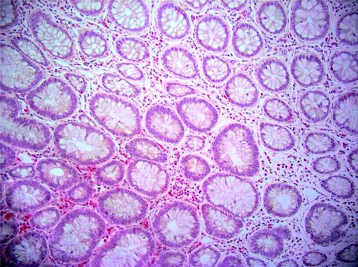 Figure 1. Normal colorectal mucosa (top right) and dysplastic crypts in an ACF (bottom left). Note the higher stromal infiltration of MPO-positive (red-stained) cells among aberrant crypts than among normal ones. Magnification, ×20.