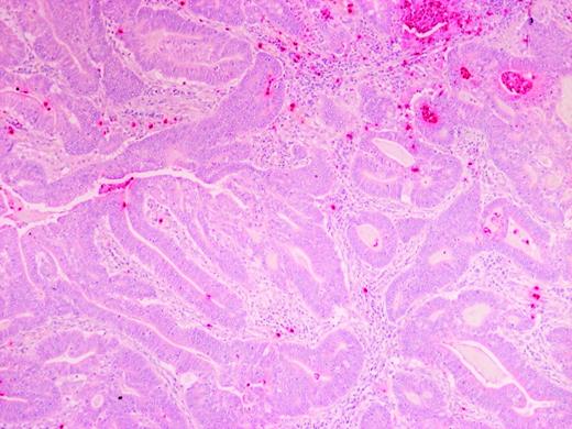 Figure 2. Colorectal carcinoma at magnification ×10. Note that the density of MPO-positive cells is higher in the upper part of the figure. Moreover, in the top right corner, necrotic and not viable cells are evident, which, as explained in the Materials and Methods, were not considered in the MPO score.