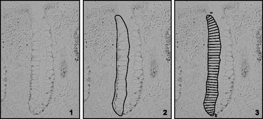 Figure 2. Molecular phenotyping is conducted by detecting the expression of various genes using automated immunohistochemistry (1). The detected expression of the genes in the tissues is quantified using custom-designed quantitative image analysis software, which measures and quantifies total expression, as well as the architecture or tissue distribution of the expression. Guided by the program, the technician selects and traces a hemicrypt (2), then the automated system divides the selection into a number of sections representing the width of an average colonocyte from the crypt base to the apex (3) and records the staining optical density.