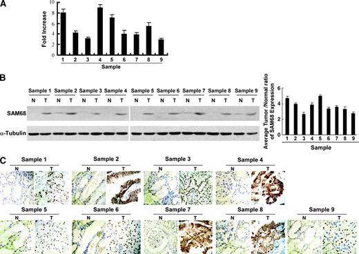 Figure 2. SAM68 expression level was up-regulated in primary renal cell carcinoma tissues compared with adjacent normal renal tissues from the same patient. A. The average tumor/normal (T/N) ratios of SAM68 expression quantified by real-time RT-PCR. Expression levels were normalized for GAPDH. Error bars, SD calculated from three parallel experiments. B. Western blotting analysis of SAM68 expression in each of the primary renal cell carcinoma tissue (T) and adjacent normal renal tissue (N) paired from the same patient(left) and the average tumor/normal (T/N) ratios of SAM68 protein expression (right). C. Immunohistochemistry confirms that SAM68 protein was up-regulated in the primary renal cell carcinoma tissue (T) compared with the paired adjacent normal renal tissue (N) from the same patient.