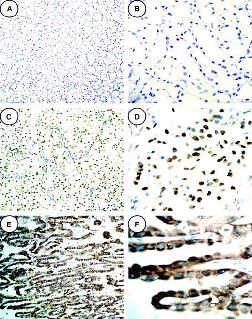 Figure 3. SAM68 protein is overexpressed in renal cell carcinoma histopathologic sections as examined by immunohistochemistry. Representative images from immunohistochemistry of 241 archived renal cell carcinoma cases, among which 129 cases were positive for SAM68. A and B. SAM68 expression in normal renal tubular epithelial cells was only marginally detectable (A, ×200; B, ×400). C and D. Expression of SAM68 in the primary lesions of renal cell carcinoma (C, ×200; D, ×400). E and F. SAM68 expression in the cytoplasm of a primary renal cell carcinoma (E, ×200; F, ×400).