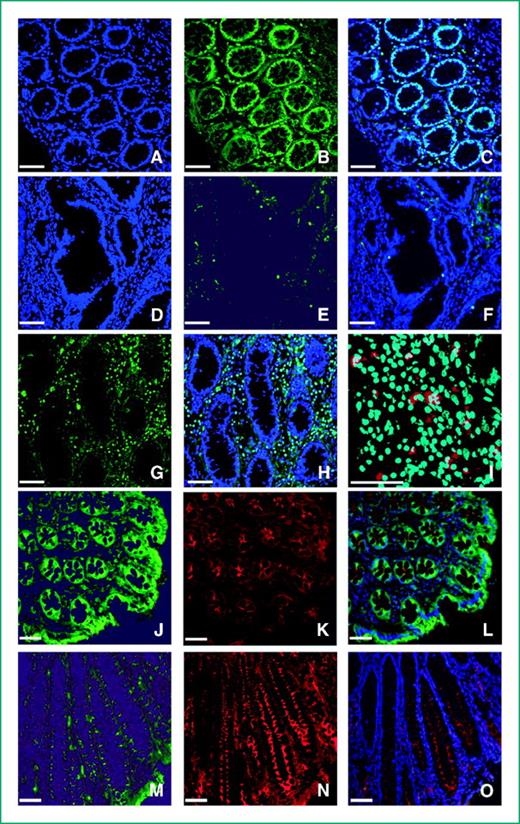 Figure 1. Confocal analysis of colonic mucosa cryosections labeled by DAPI (blue), anti-Cleaved PARP-1 (green), anti–Pro-Collagen I (red), anti–Caspase-3 active (green), and anti–Bcl-2 (red). A to C, normal colorectal mucosa (A, DAPI; B, anti-Cleaved PARP-1; C, merge). The presence of several apoptotic epithelial cells is evident, as revealed by nuclear labeling and DAPI coimmunostaining. D to F, microadenomas (D, DAPI; E, anti-Cleaved PARP-1; F, merge). The number of positive epithelial cells was steadily lower; microadenomas do not show an appreciable PARP-1 staining of stromal cells. G to I, normal colorectal mucosa (G, anti–Cleaved PARP-1; H, DAPI + anti–Cleaved PARP-1; I, merge + anti–Pro-Collagen I). The presence of apoptotic stromal cells is markedly evident; I, apoptotic fibroblast-like cells. J to O, normal mucosa (J-L), microadenomas (M-O; J and M, anti–Caspase-3 active; K and N, anti–Bcl-2; L and O, merge + DAPI). Caspase-3 active protein is localized mainly at the lateral borders of goblet cells both in normal colorectal mucosa (J) and in microadenomas (M); Bcl-2 accumulated predominantly at the apical region of epithelial cells toward the lumen of colonic crypts. Note that Caspase-3 active immunostaining intensity is higher in normal colorectal mucosa with respect to microadenomas (J and M); the Bcl-2 expression level trend was the opposite of Caspase-3 (K and N). Bar, 52 μm.