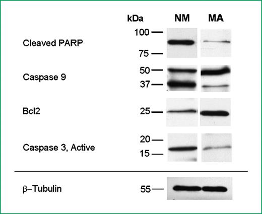 Figure 4. Western blot of proapoptotic (Cleaved PARP-1, Caspase-9, and Caspase-3 active) and anti-apoptotic (Bcl-2) proteins in normal mucosa (NM) and in microadenomas (MA) samples. Anti–Cleaved PARP-1 antibody recognizes a single intense band at the expected molecular weight (89 kDa) in normal colorectal mucosa and a very low band is slightly detectable in the microadenomas sample; full-length Caspase-9, stand for the 47-kDa band, was more evident in microadenomas, whereas the band of cleaved Caspase-9 at 37 kDa was well detectable in normal colorectal mucosa, but was very slightly in microadenomas; the band corresponding to Caspase-3 active, at 17 kDa, is well evident in normal colorectal mucosa and is hardly detectable in microadenomas; anti–Bcl-2 antibody recognizes, at 25 kDa, a strong band in microadenomas and a slightly appreciable band in normal colorectal mucosa. β-Tubulin is used as loading control.