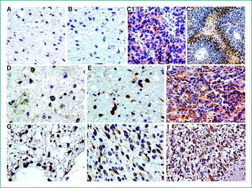Figure 2. Immunohistochemical staining pattern of IGFBP-2, -3, and -5. Representative micrographs showing staining of IGFBP-2 (A, B, C1, and C2), IGFBP-3 (D, E, and F), and IGFBP-5 (G, H, and I). DA staining (A, D, and G), AA staining (B, E, and H), and GBM staining (C1, C2, F, and I). C2 represents pseudopalisading necrosis region in a GBM section. All original magnifications are ×400 except in C2, which is ×100.