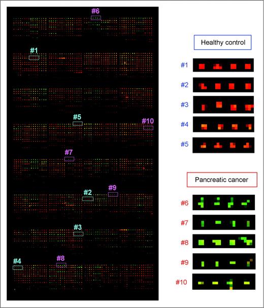 Figure 2. Image of a representative reverse-phase protein microarray slide stained with anti-PBP antibody (left). Samples were randomly assigned, and quadruplicate spots from representative patients with high and low levels of CXCL7 were extracted (right).
